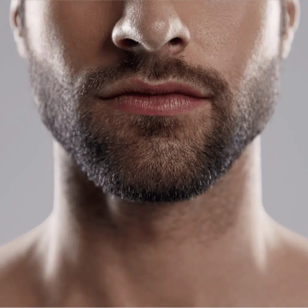 beard growth with Minoxidil